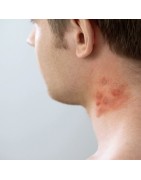 Herpes Y Hongos